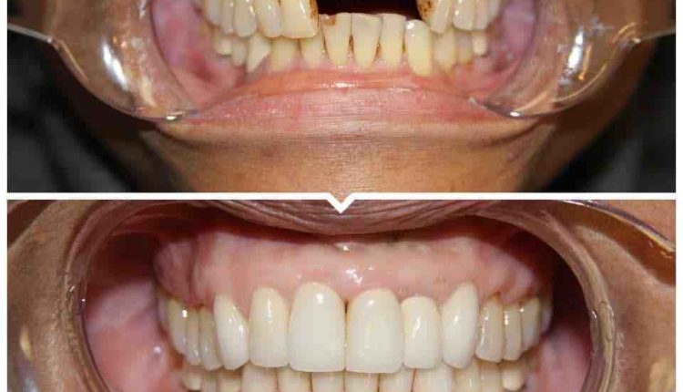 What is experience with dental implants