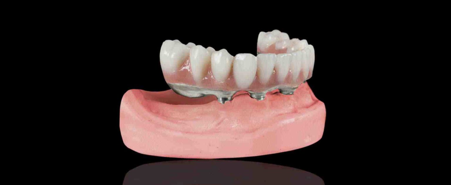 What is hybrid dental implants Dental News Network