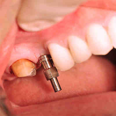 What is that implant dental?