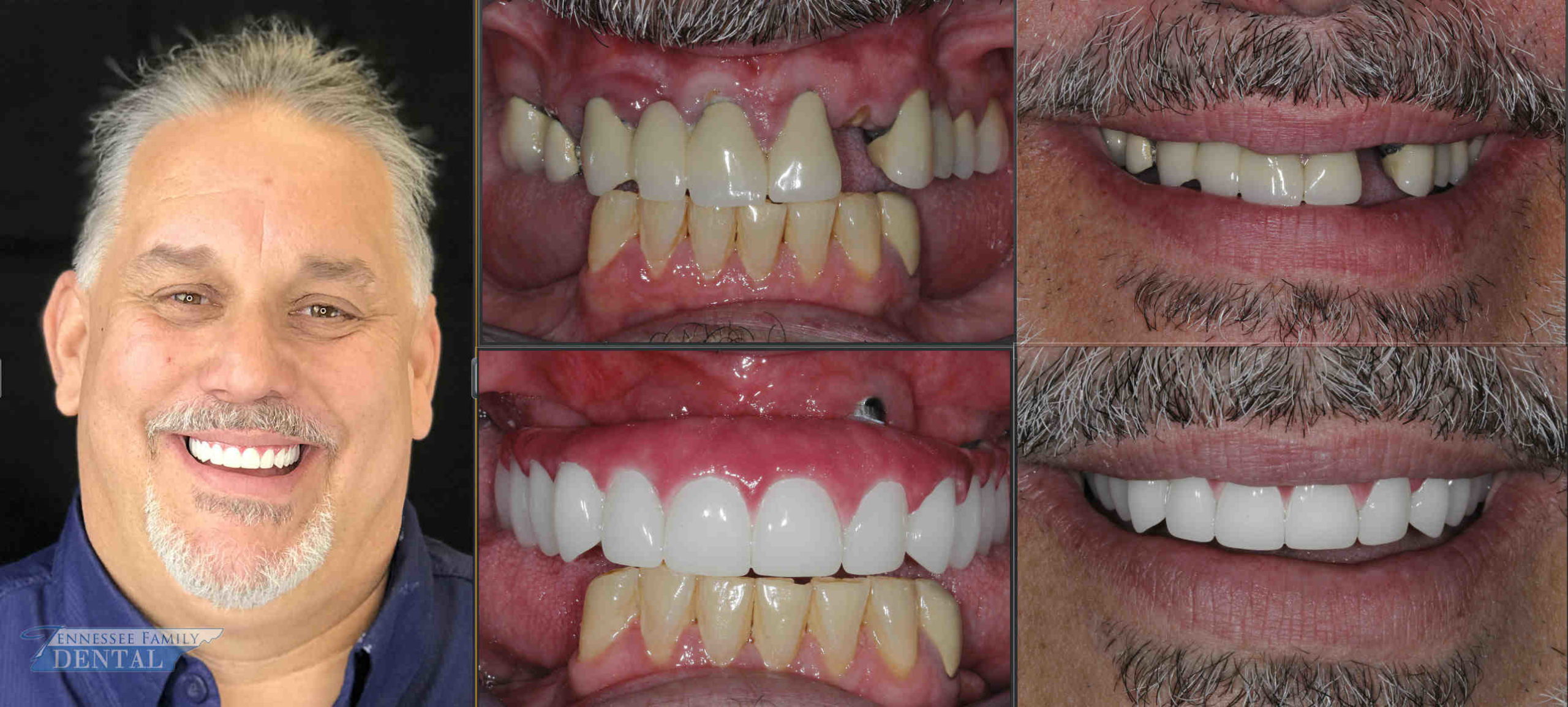 What is the average cost for a full set of dental implants?