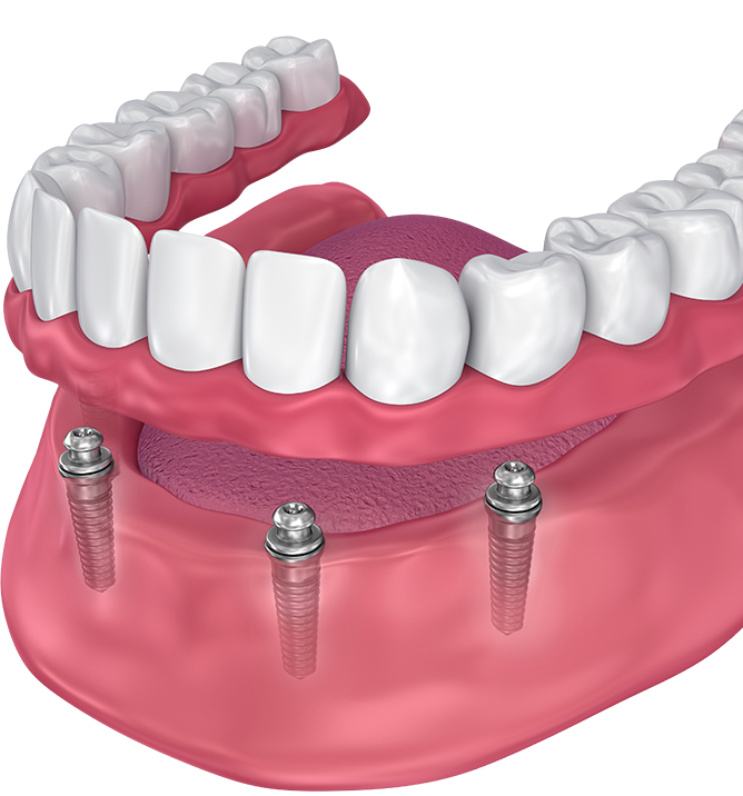 What is the average cost of full dental implants?