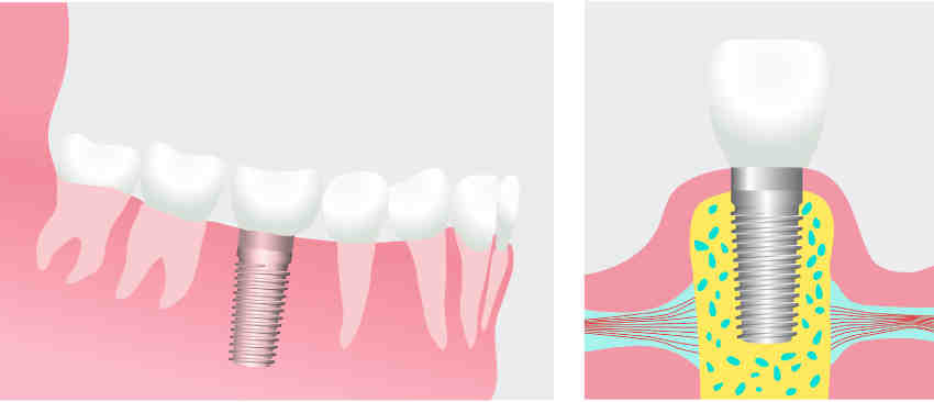 What is the average price of a full set of dental implants?