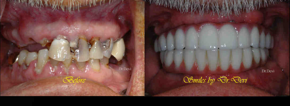 What is the best doctor to do dental implants?