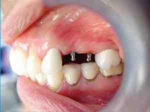 What is the difference between regular and mini dental implants?