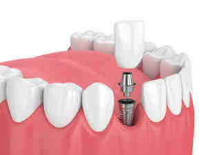 What is the healing process for dental implants?