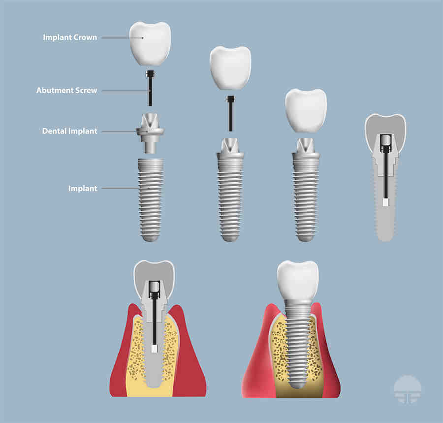 How long are dental implant screws - Dental News Network