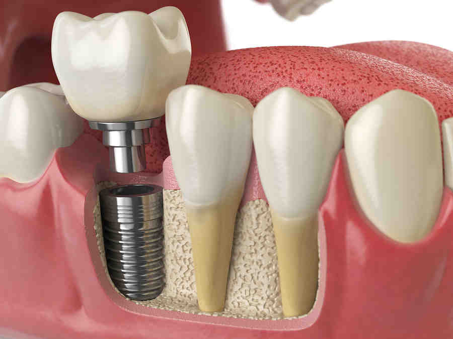 How long are dental implant screws Dental News Network