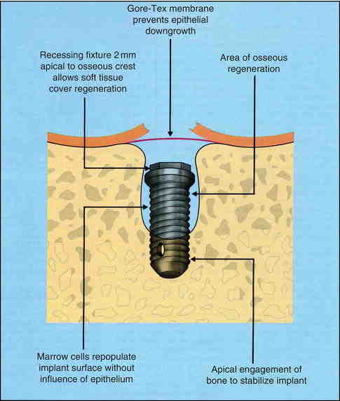 What makes you a bad candidate for dental implants?