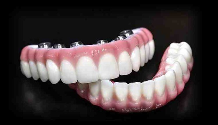 What should a dental implant cost