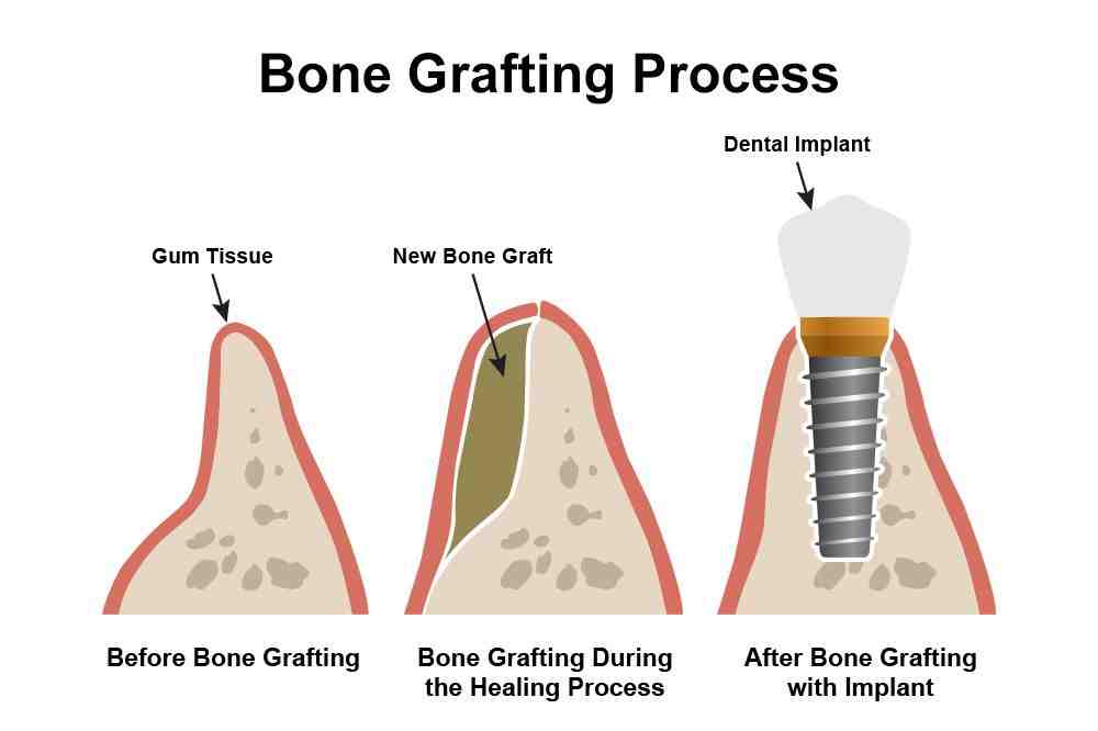 What to eat while implants are healing?
