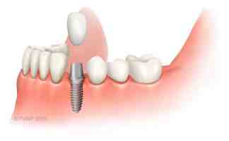 What type of metal is used in a dental implant?