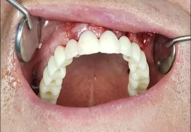 What will help in healing dental implants for bone and tissue