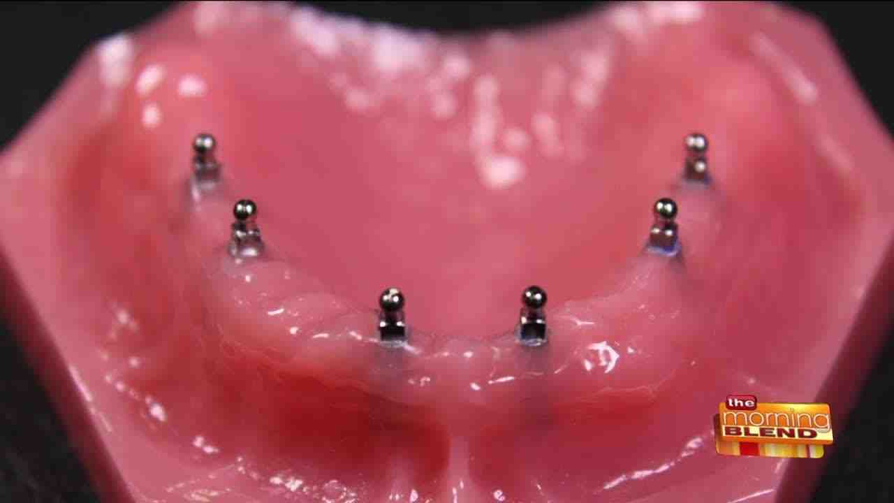 What's the average cost of mini implants?