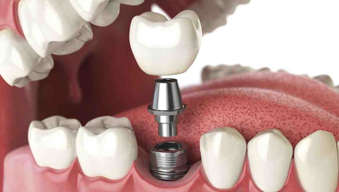 When can I brush implant site?
