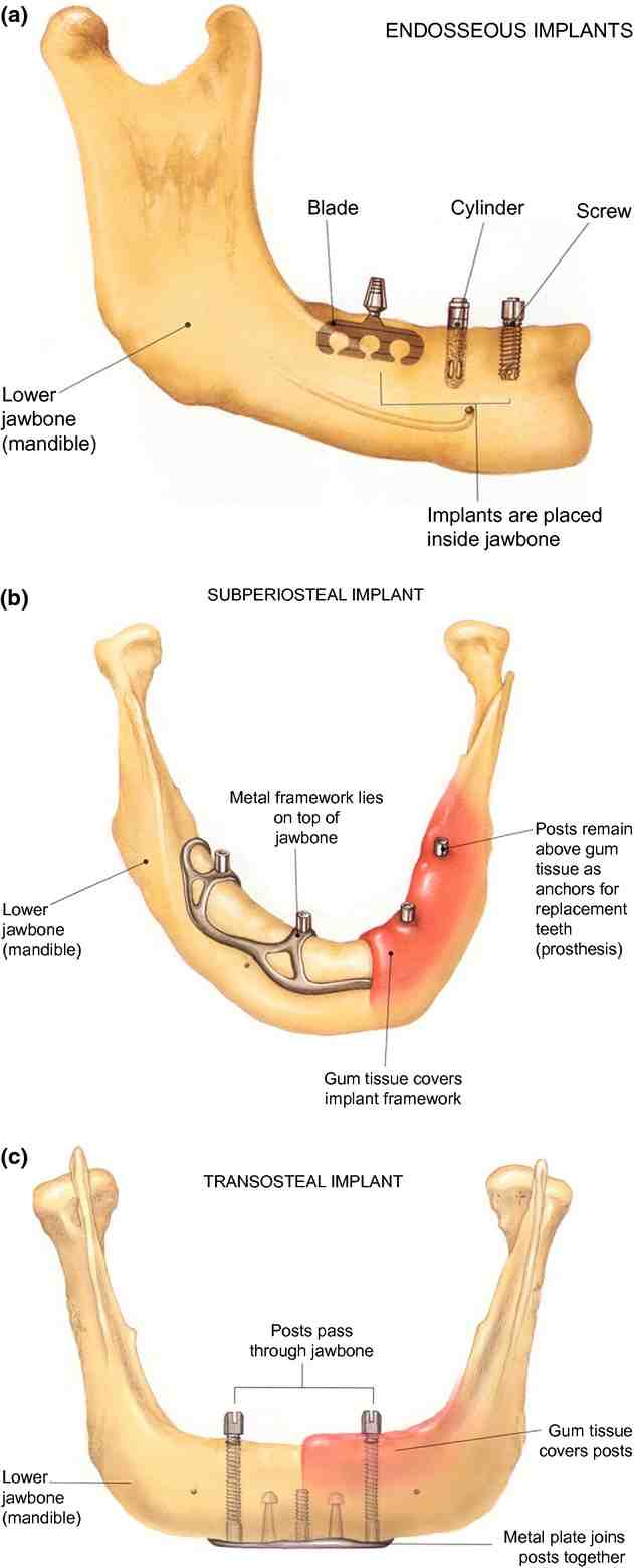 What are contraindications for dental implants Dental News Network