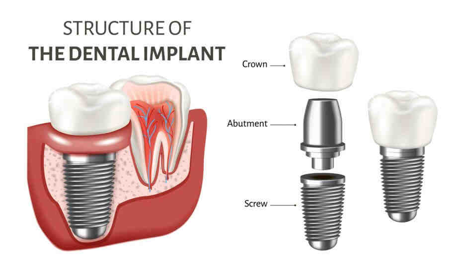 When was the first dental implant?