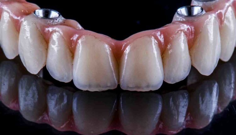 Who does dental implants in central nj