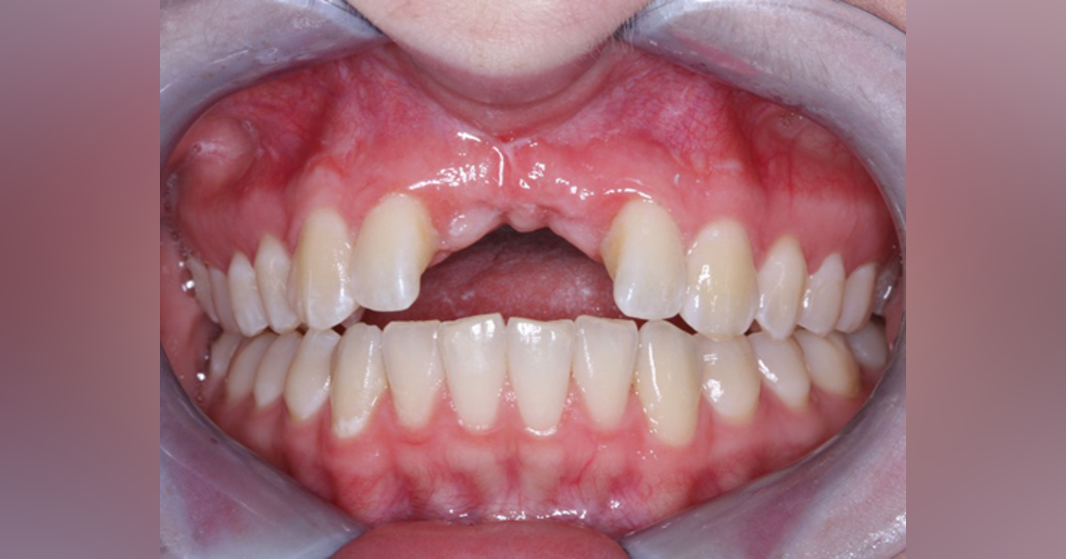 Who introduced dental implants?