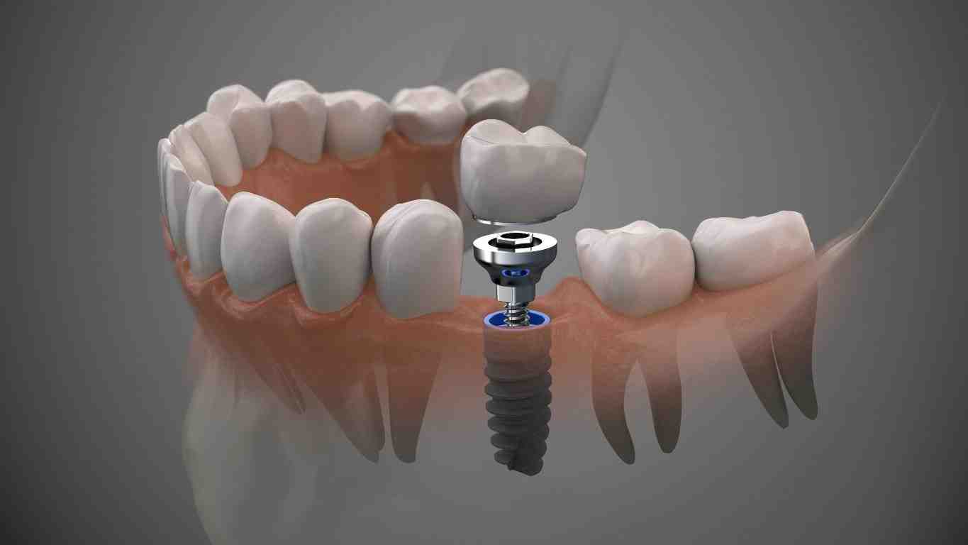 Who is not suitable for dental implants?