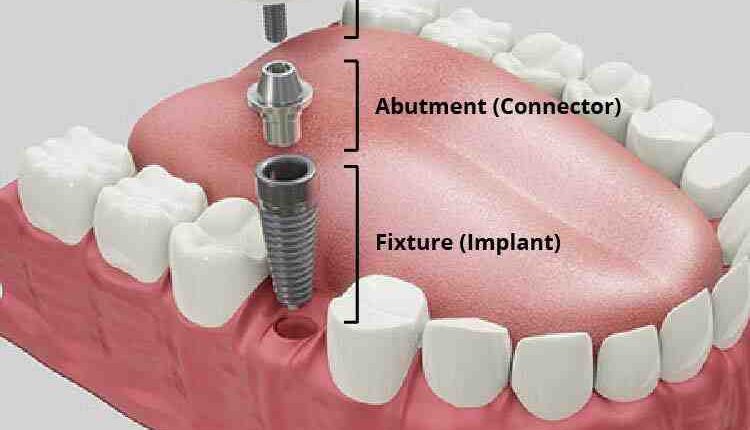 Who makes dental implants