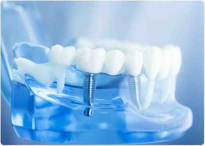 Who makes teeth for implants?