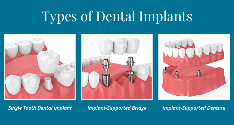 Who performs dental implants