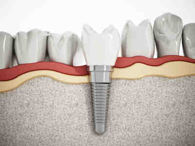 Who places an implant?