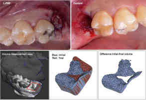 Why choose a dental bridge over a dental implant?