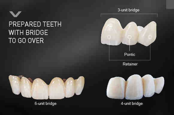 What is a dental bridge cost vs implant? - Dental News Network