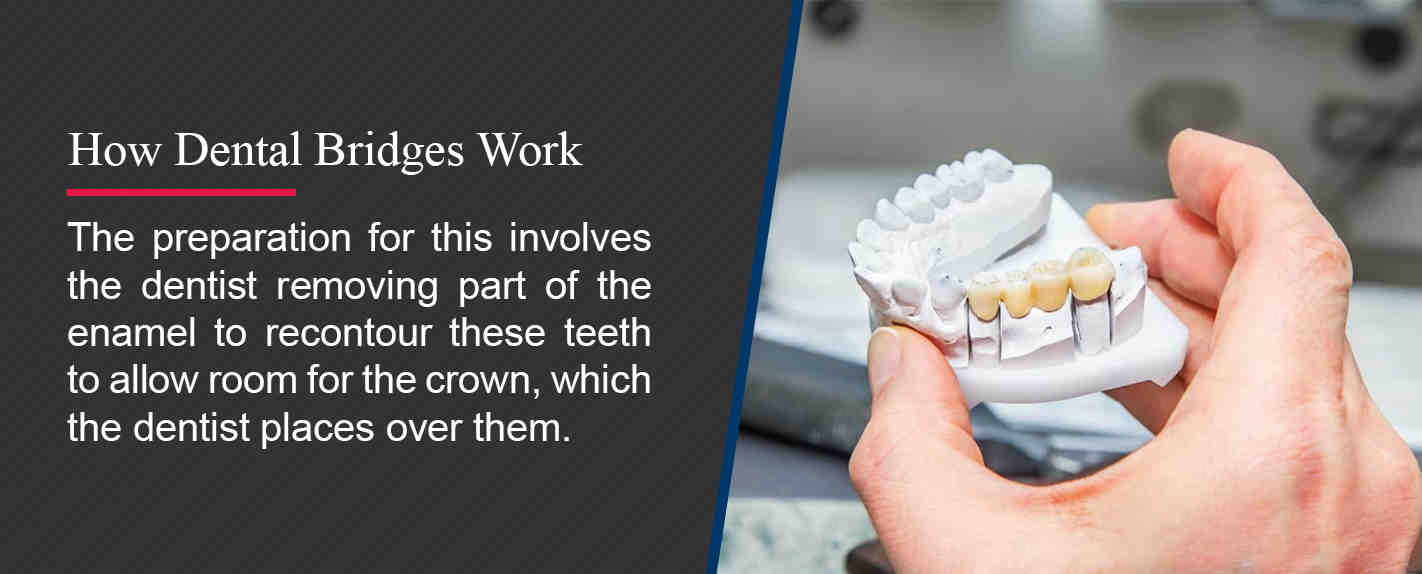 Why choose a dental bridge over an implant?