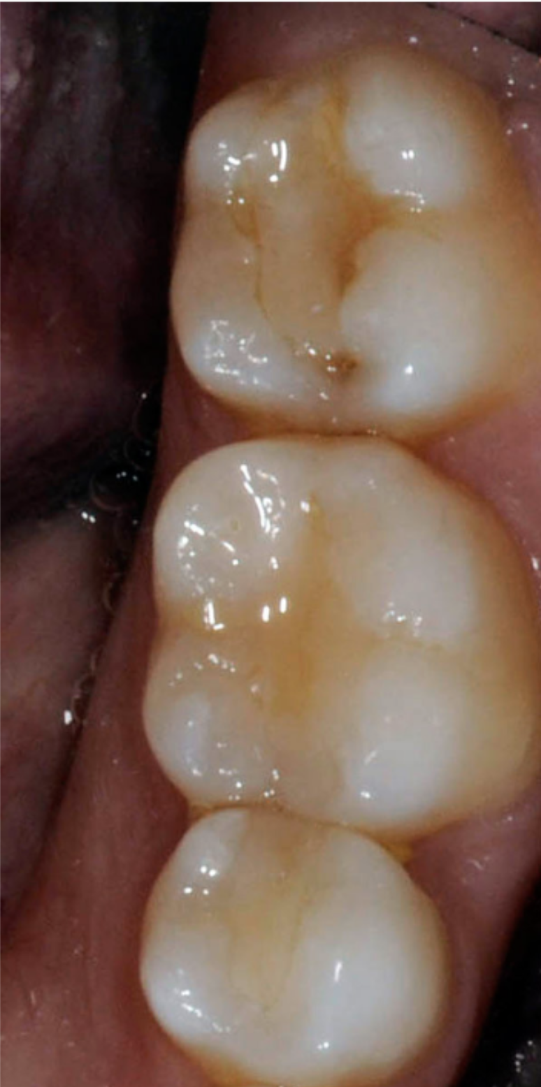 Why do implants have expiration dates?