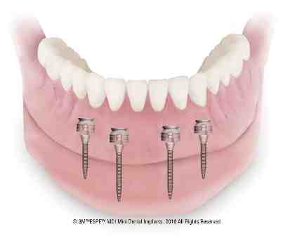 Why do mini dental implants fail?