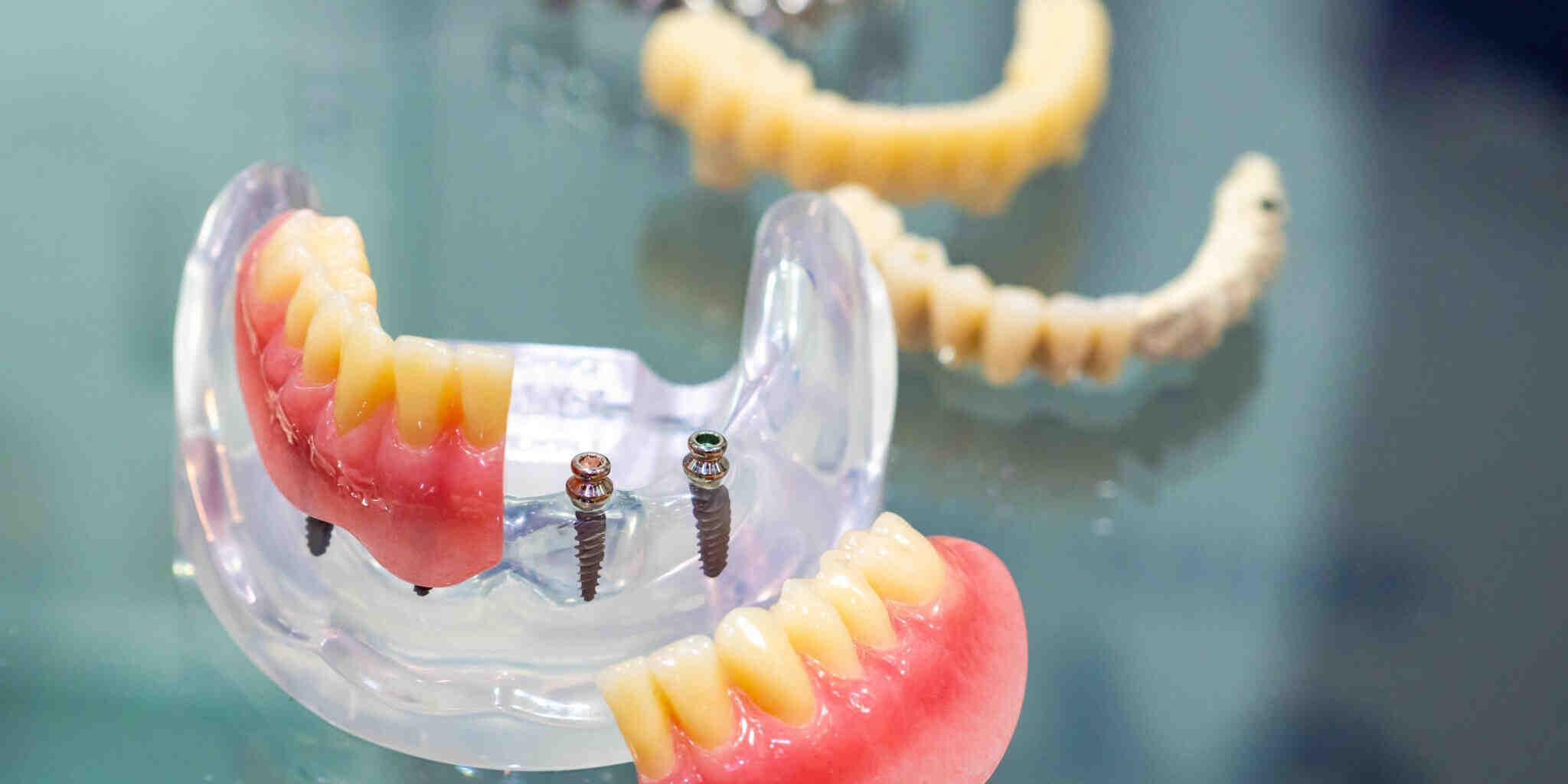 Why do mini implants fail?