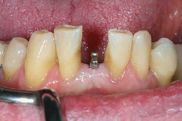 Why do mini implants fail?