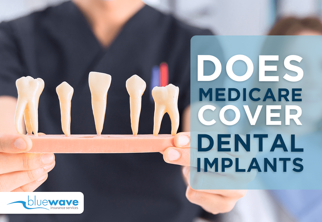 Is dental implants covered by medicare Dental News Network