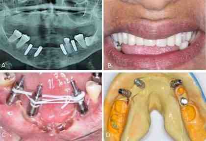 Will dental insurance pay for an implant?