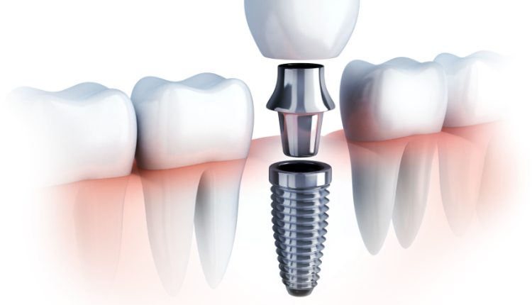 Will the price of dental implants ever go down