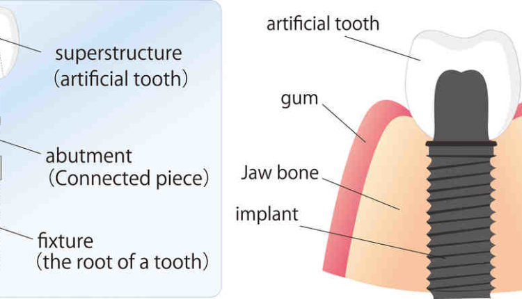 will-va-pay-for-dental-implants-dental-news-network