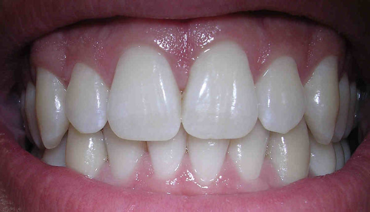 ____ 6. why are dental implants significant for patients?