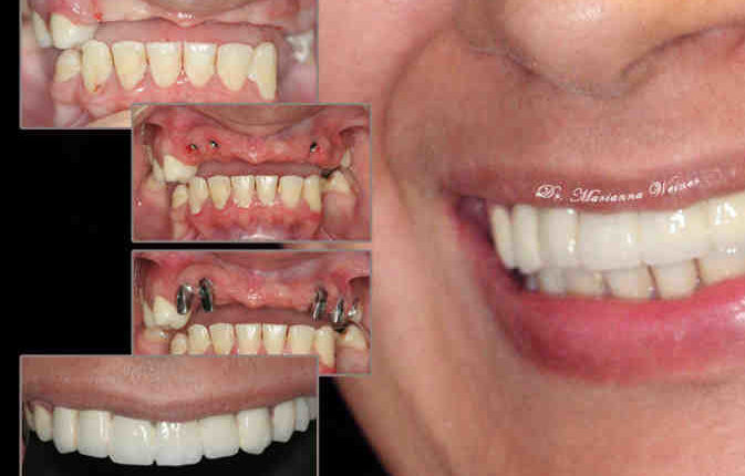 Are dental implants considered cosmetic