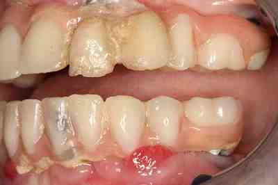 Are dental implants hard to clean?