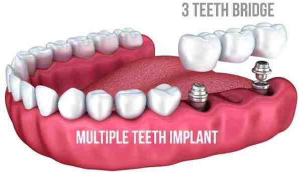 Are dental implants worth it?