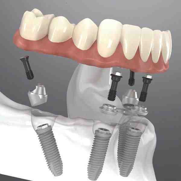 Are implant supported dentures worth it?