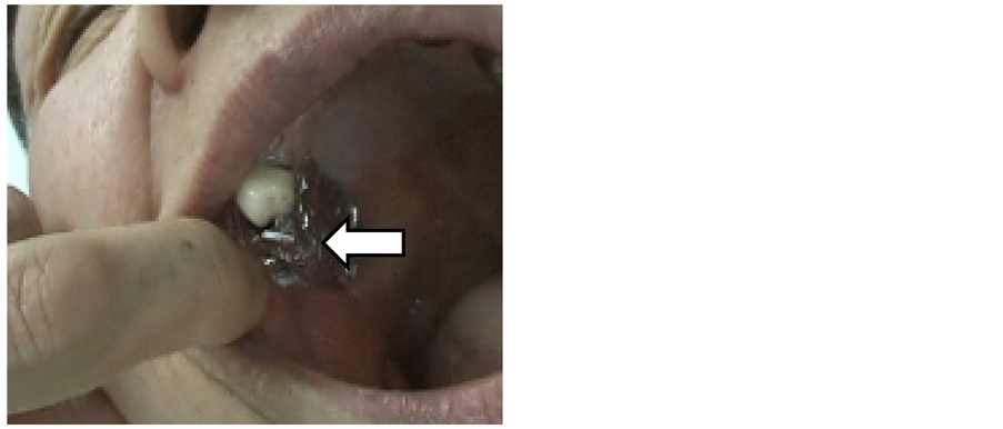 Are my dental implants making me sick?