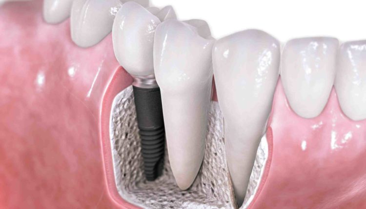 Are there payment plans for dental implants