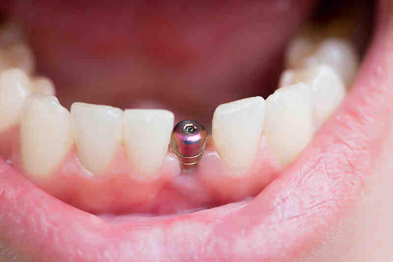 Are titanium dental implants safe Dental News Network