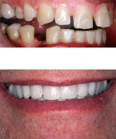 Are veneers pretty?