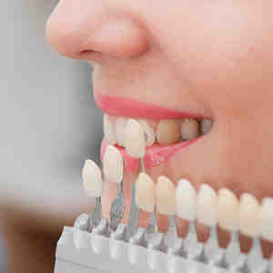 Are veneers pretty?