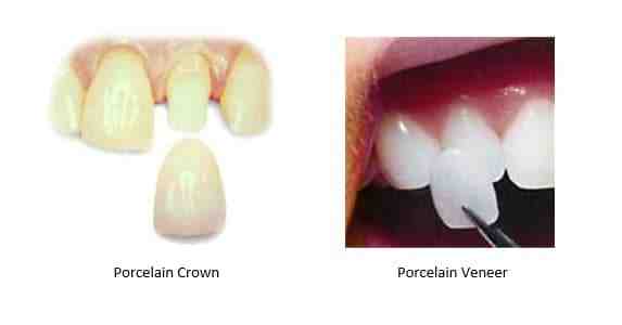 Cosmetic dentistry veneers vs crowns real self - Dental News Network