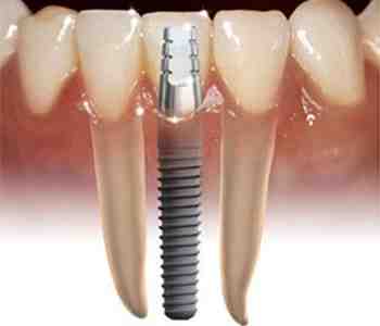 Can 2 crowns go on one implant?